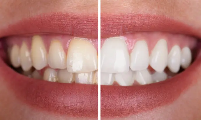 Bleaching Münster